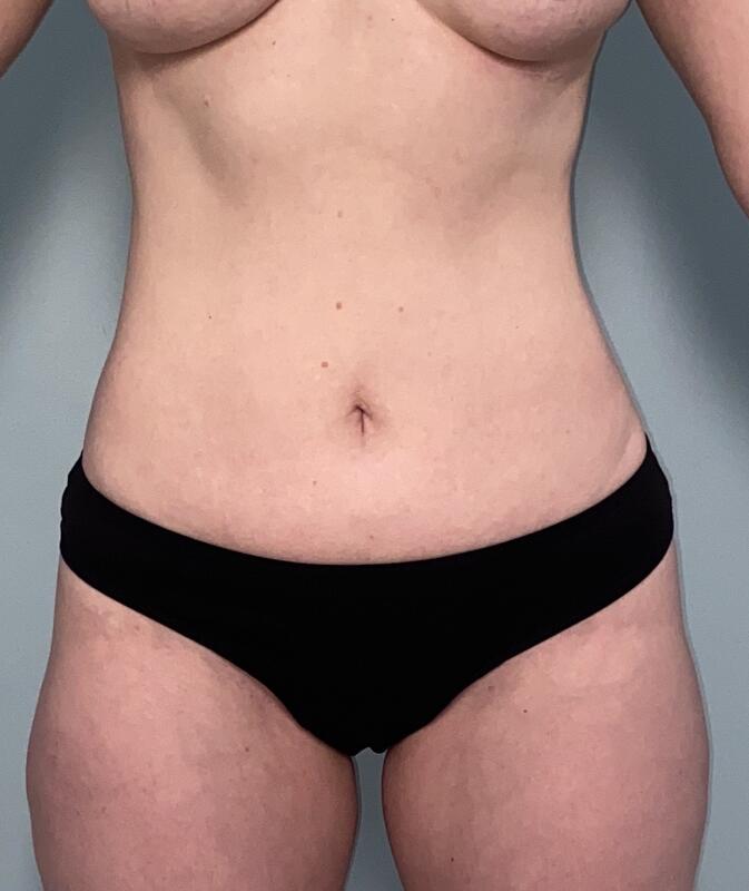 Liposuction Before & After Image