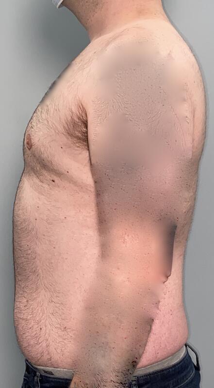Gynecomastia Before & After Image